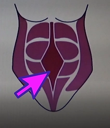 diastasis abdominal-1